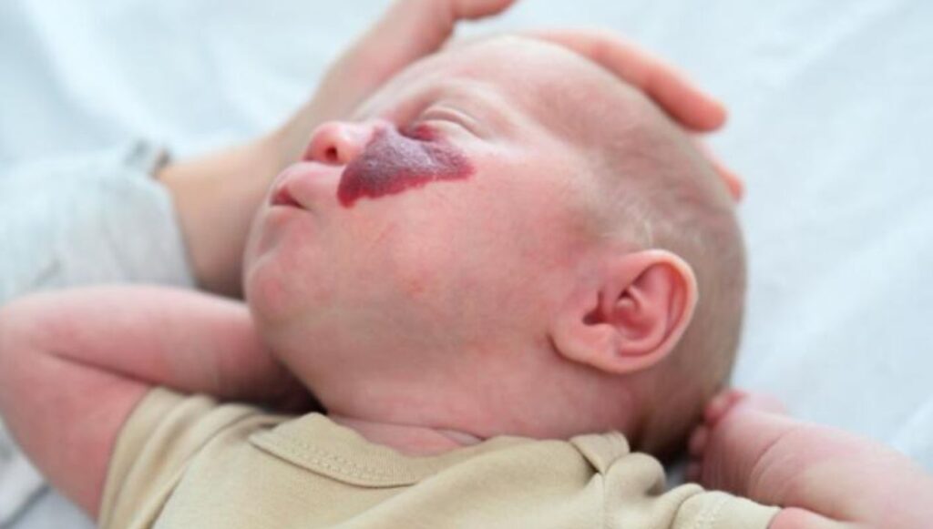الوحمة الدموية عند الرضع