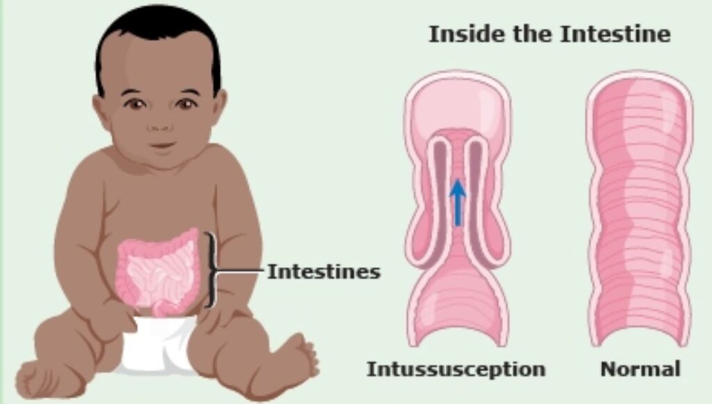 الانسداد المعوي
