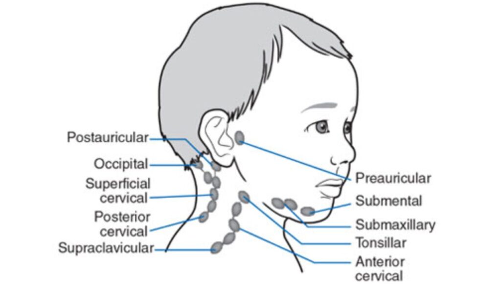 التهاب الغدد الليمفاوية