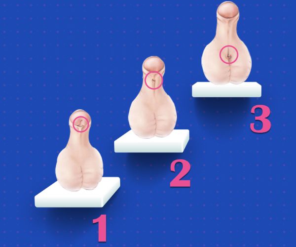  الاحليل السفلي