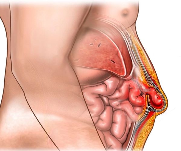 الفتق الاربى عند الاطفال