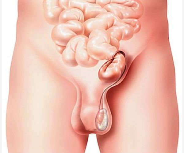 الفتق الاربى عند الاطفال