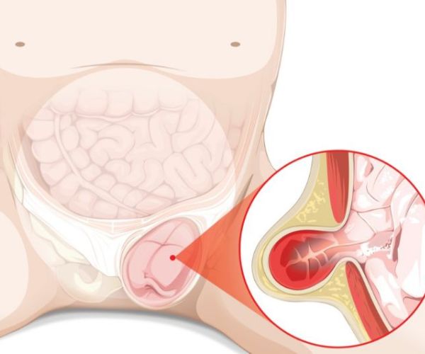 الفتاق في الخصية