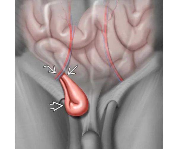 الفتاق في الخصية