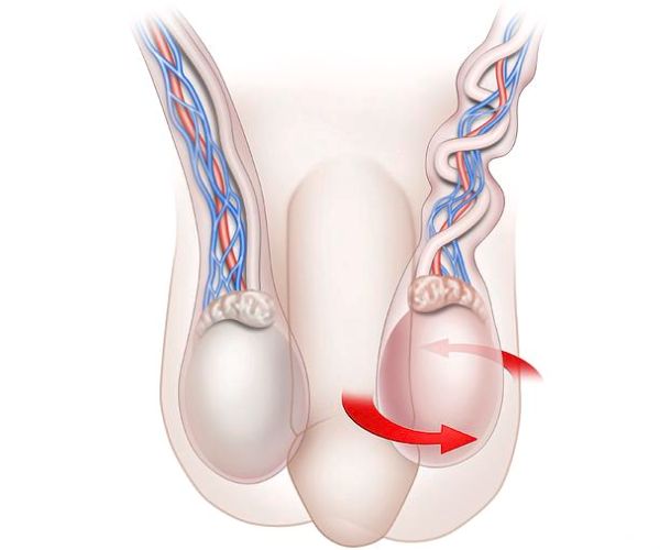 التواء الخصية