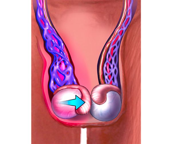 التواء الخصية