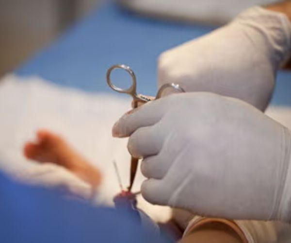 الختان الخاطئ لِلذُكور