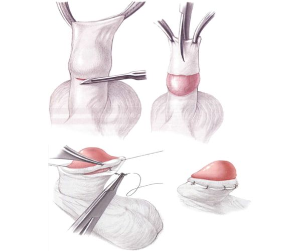 علاج التصاق الجلد بالحشفة بعد الختان