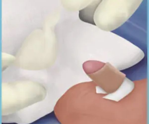 علاج التصاق الجلد بالحشفة بعد الختان