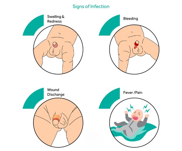علاج التصاق الجلد بالحشفة بعد الختان
