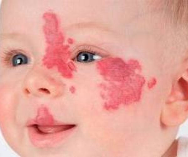 الوحمة الدموية عند الرضع