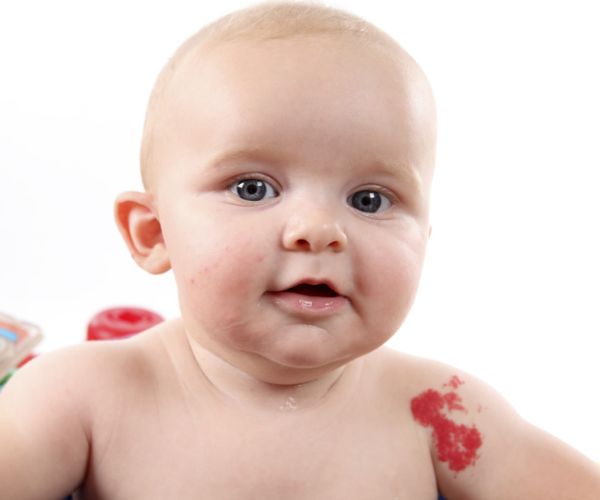 الوحمة الدموية عند الرضع