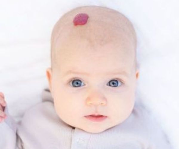 الوحمة الدموية عند الرضع