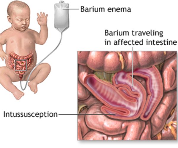الانسداد المعوي