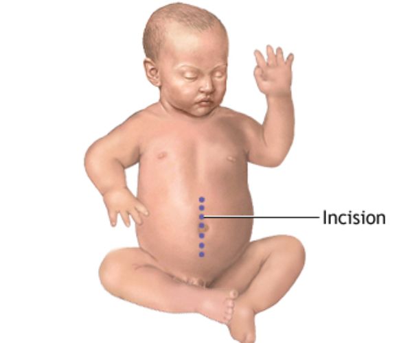 الانسداد المعوي