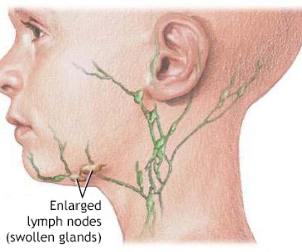 التهاب الغدد الليمفاوية