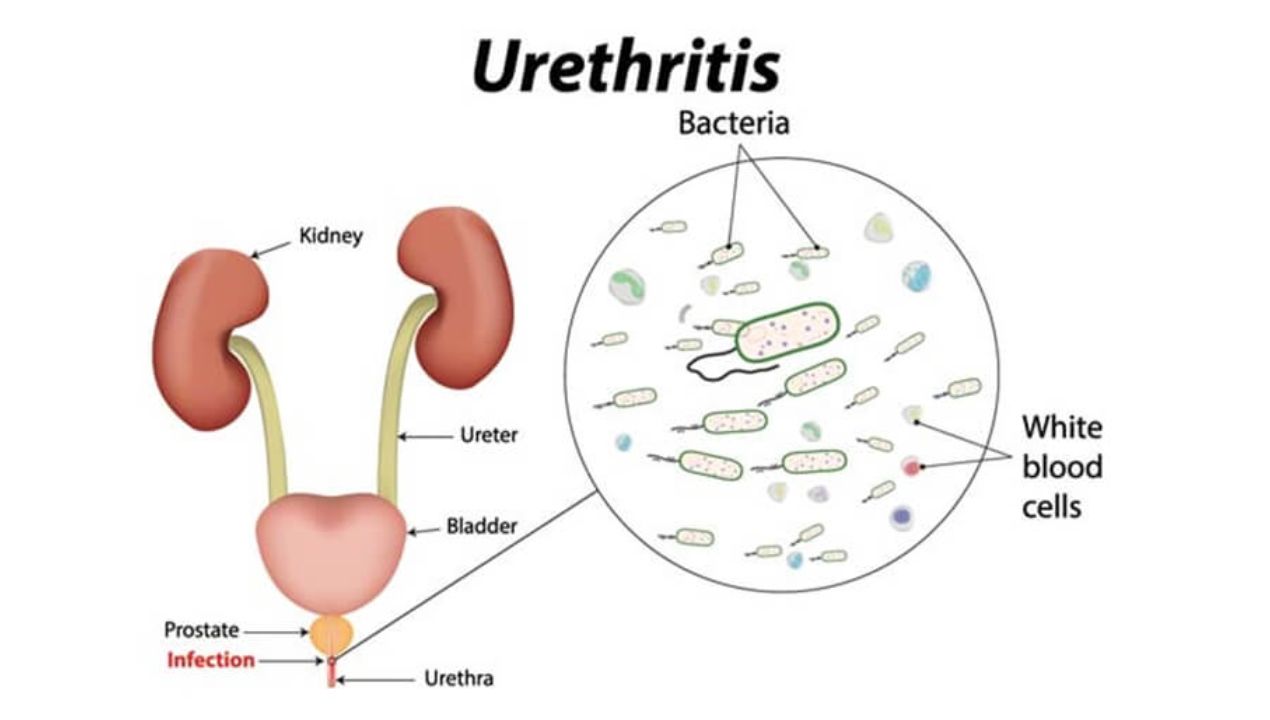 اسباب التهاب الاحليل عند الاطفال واعراضه وعلاجه