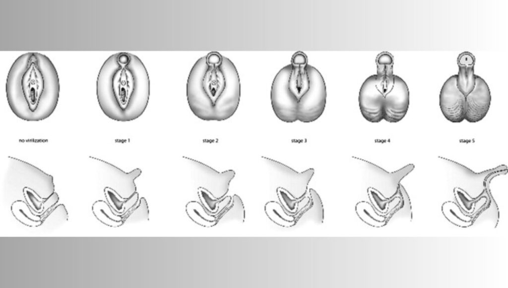 تشوهات الاعضاء التناسلية عند حديثي الولادة