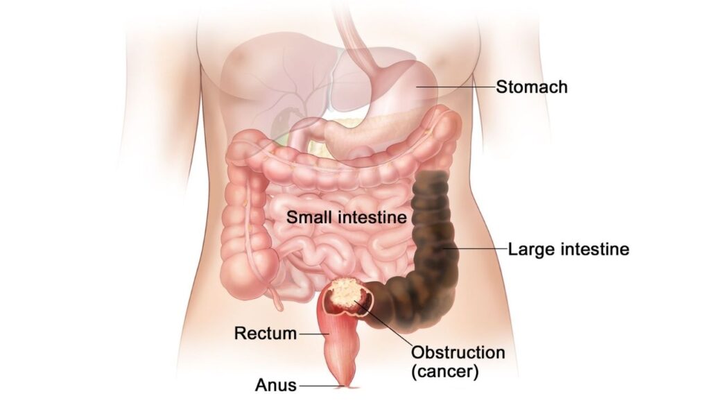 انسداد الامعاء