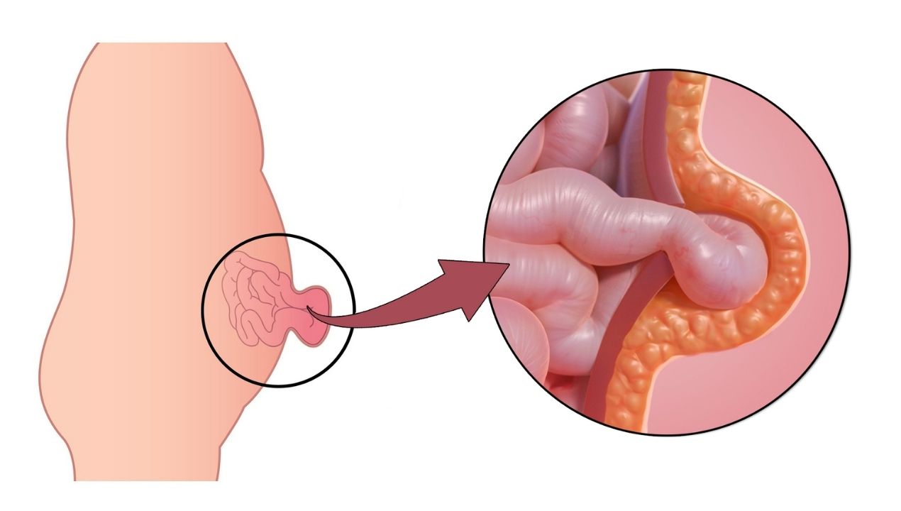 دليل شامل: أعراض الفتق السري وأسبابه وطرق علاجه