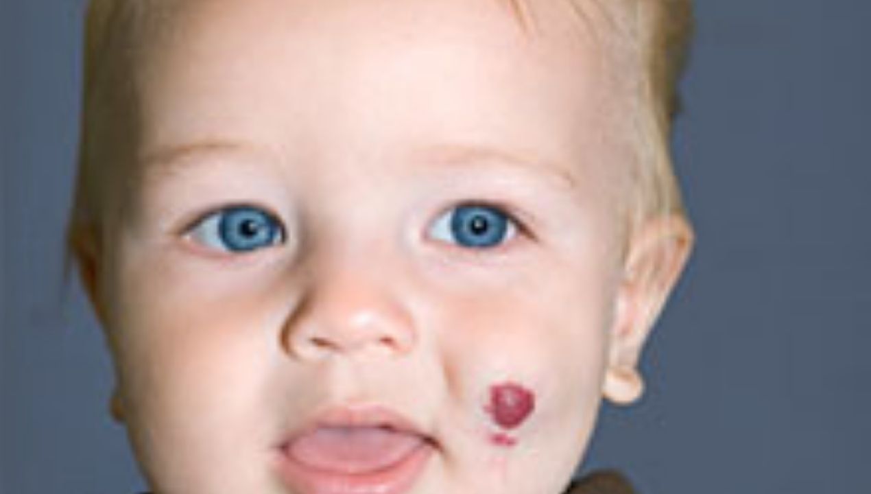 ما هي الوحمة الدموية وما أنواعها وطرق علاجها؟