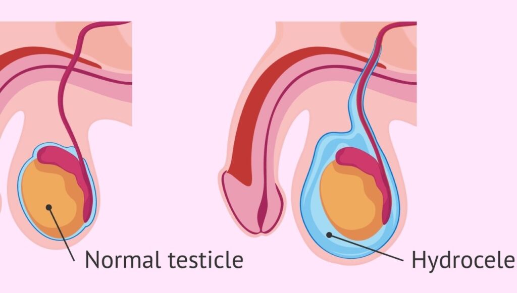 الماء في الخصيه