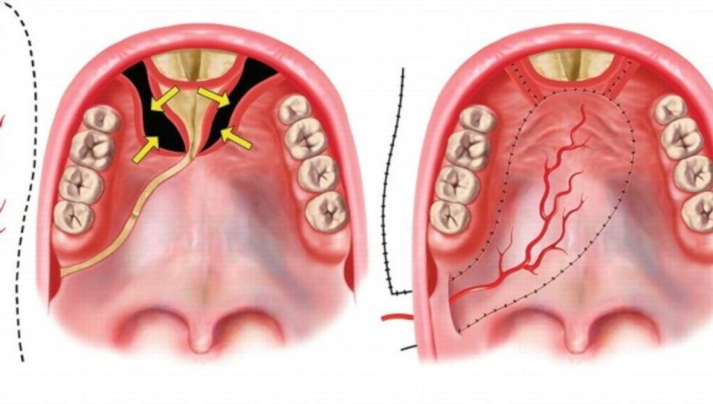 فشل عمليات سقف الحلق