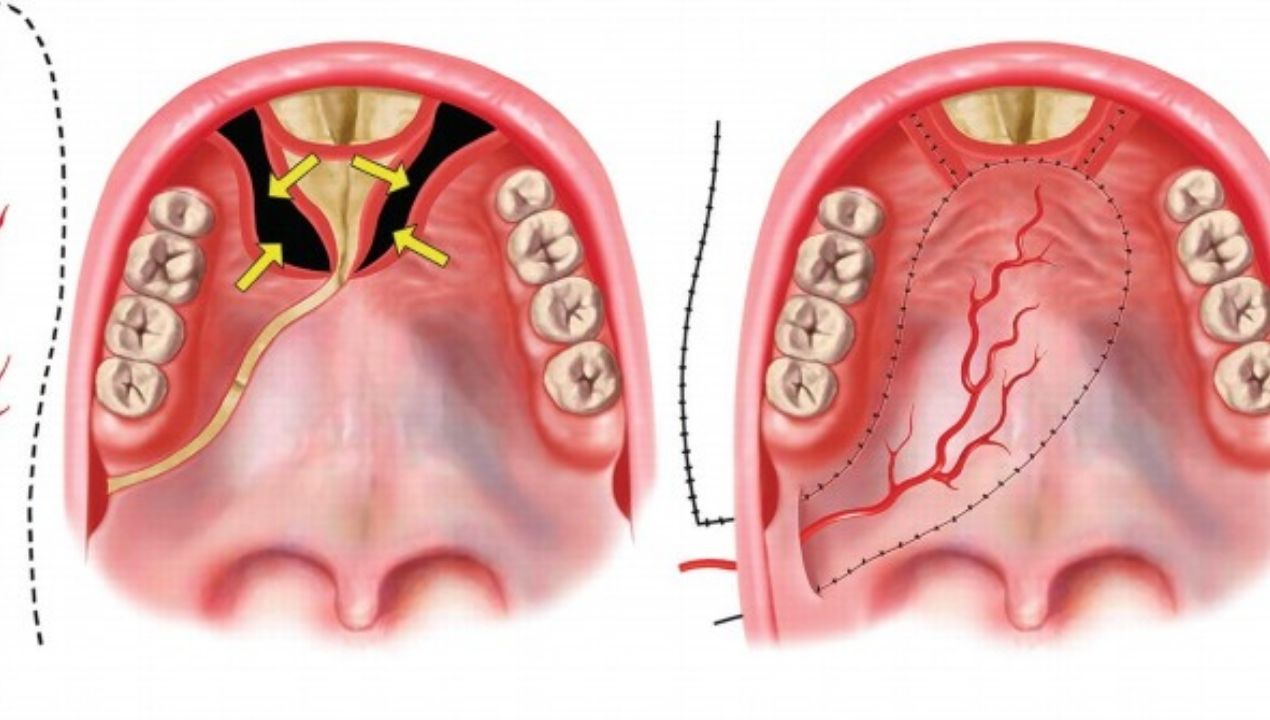 تعرف علي أسباب فشل عمليات سقف الحلق