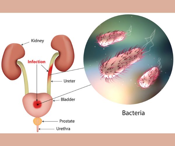 التهاب الاحليل