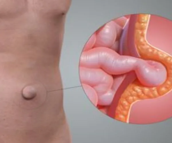 تعرف علي شكل الفتق السرى وأسبابه بالصور 6 شكل الفتق السرى