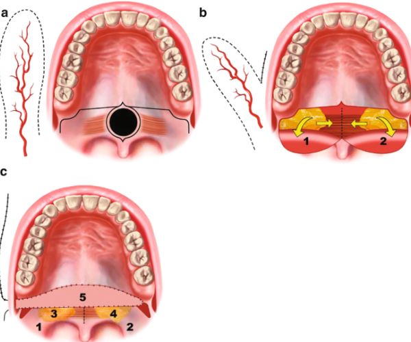فشل عمليات سقف الحلق