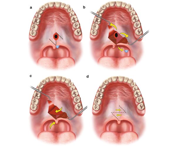فشل عمليات سقف الحلق