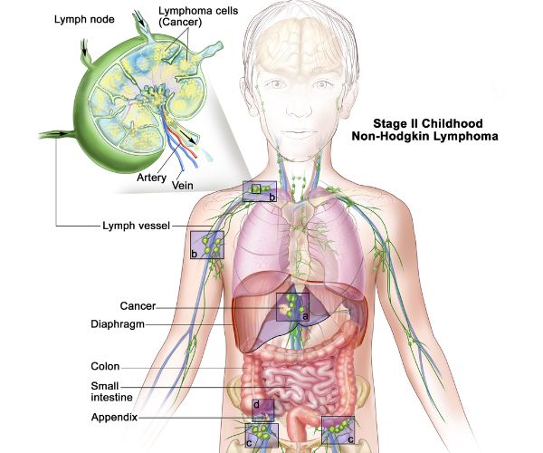 سرطان الغدد الليمفاوية