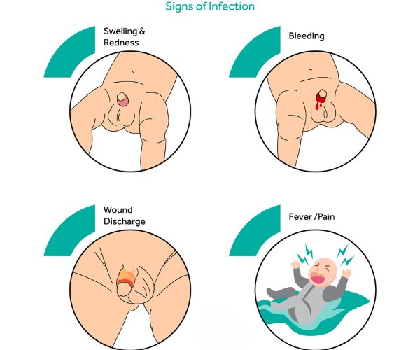 مراحل شفاء الختان
