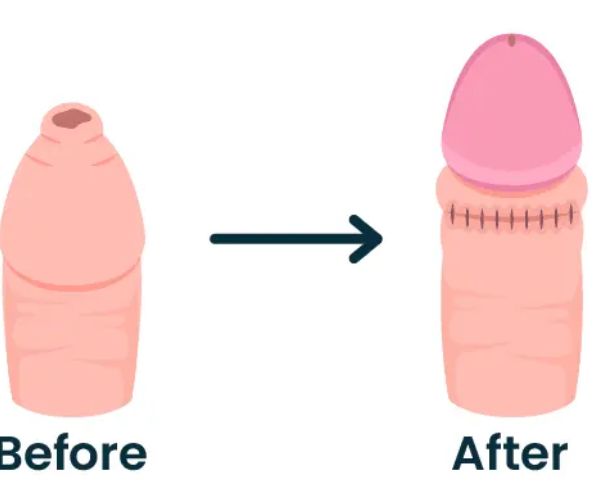 مراحل شفاء الختان