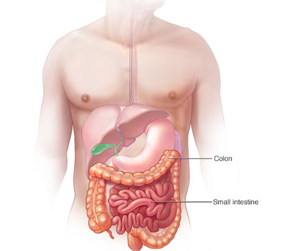 انسداد الامعاء