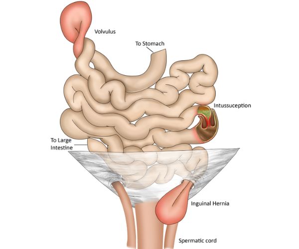 انسداد الامعاء