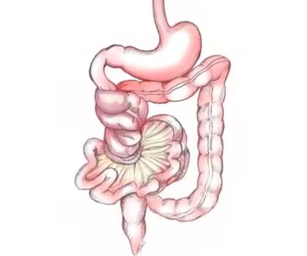 انسداد الامعاء