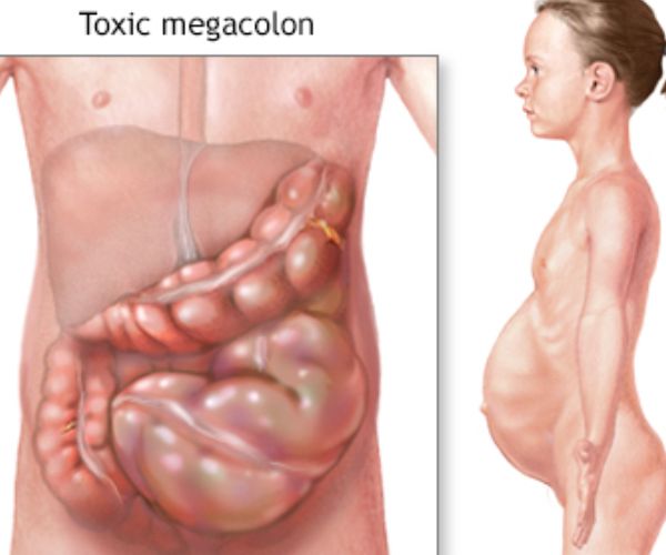 اعراض تضخم القولون