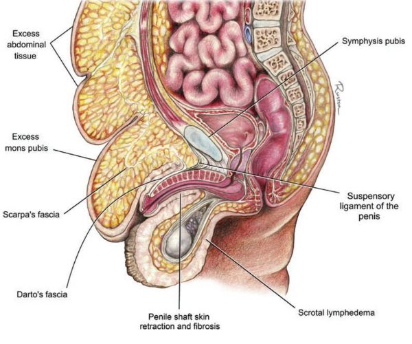 القضيب المدفون