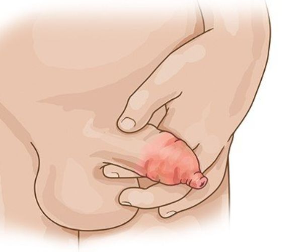 التهاب العضو الذكرى عند الاطفال