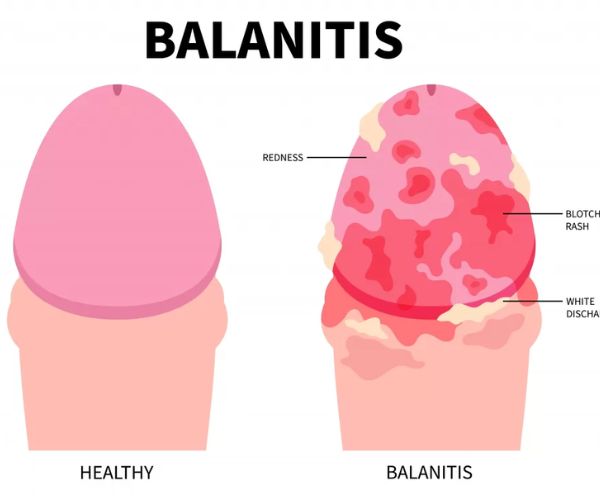التهاب العضو الذكرى عند الاطفال