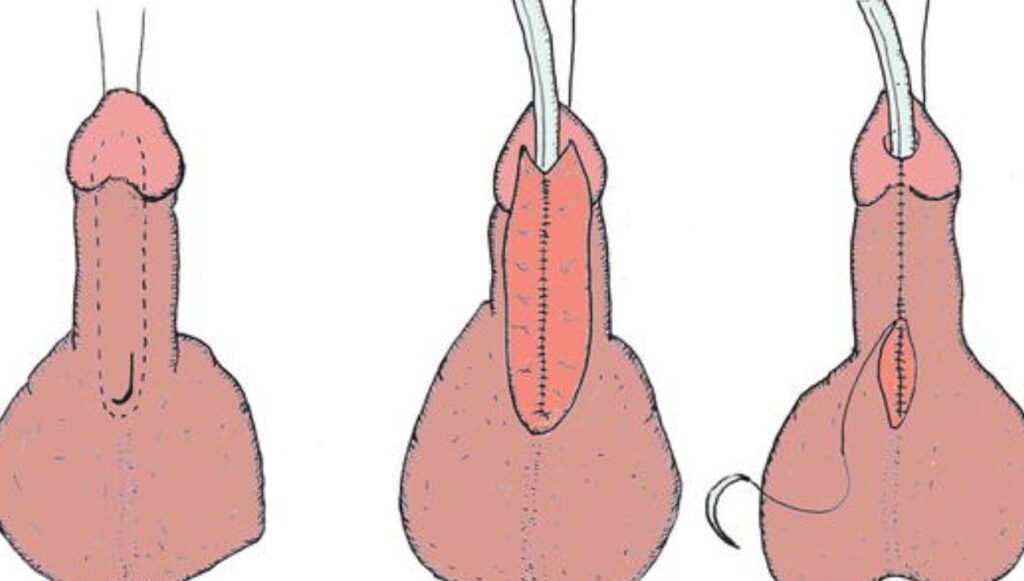 عملية الاحليل السفلي