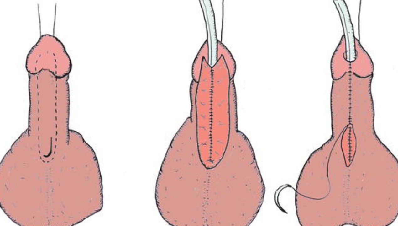 كم تكلفة عملية الاحليل السفلي في مصر 2025؟