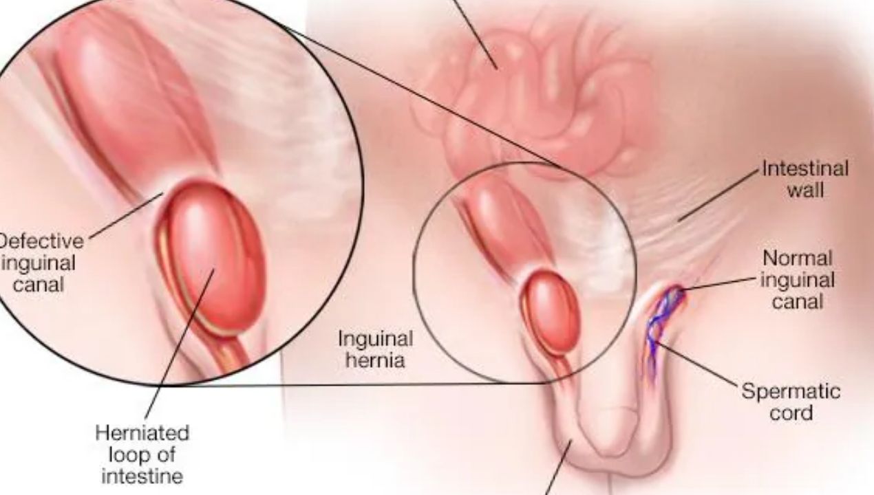 دليل شامل: علاج فتق الخصية بدون جراحة عند الأطفال