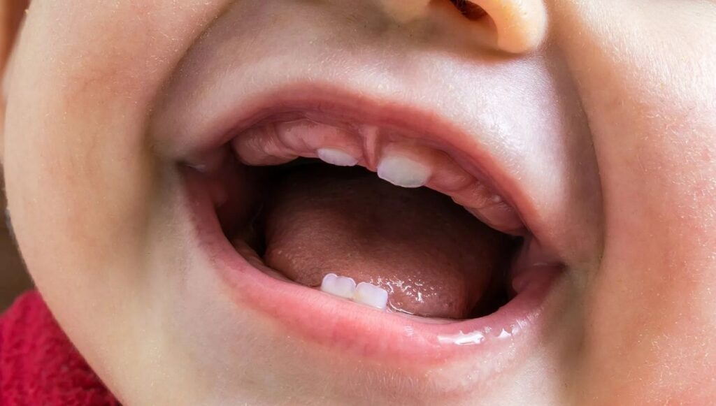 الشفة المربوطة عند الرضع