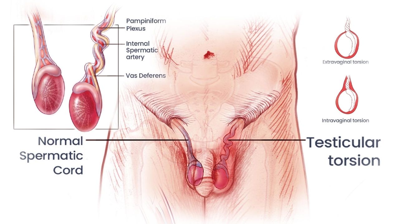 ما بعد عملية التواء الخصية: نصائح التعافي والمضاعفات