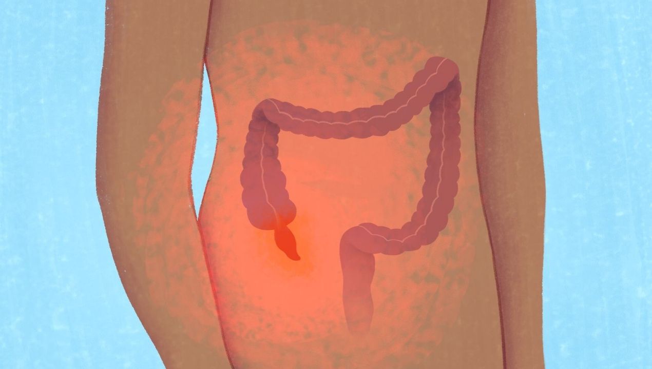 هل ألم الزائدة الدودية مستمر أم متقطع؟ الأعراض والمخاطر