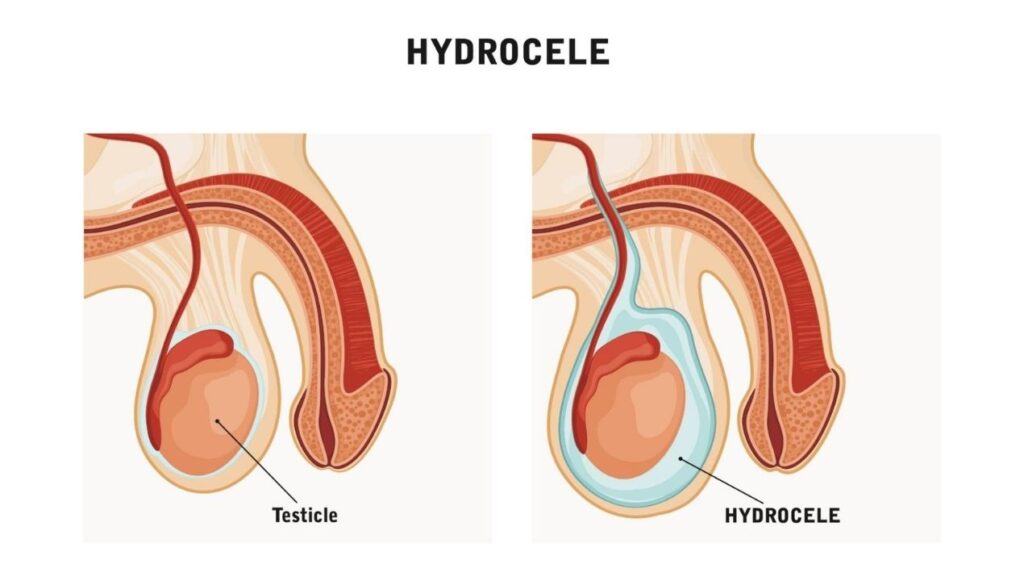 علاج كيس الماء في الخصية