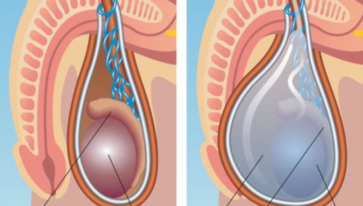 ما هي القيلة المائية على الخصية اليسرى؟ الأسباب وطرق التشخيص